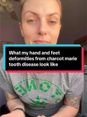 Here are my hand and foot deformities (from charcot marie tooth disease) #charcotmarietooth #charcotmarietoothdisease #cmt2 #sensoryneuropathy #motorneuropathy #musculardystrophy #muscularatrophy #charcothand #hammertoes #deformities