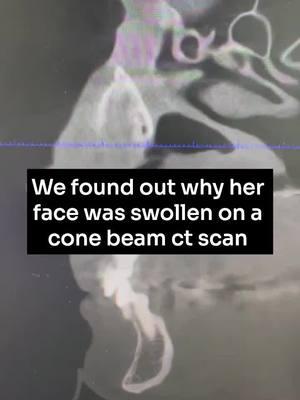 🚨 Severe Dental Infection Alert! 🚨 A patient came in today with swelling on the left side of her face and into her nose. After two rounds of antibiotics with little relief, we discovered the cause using a cone beam ct scan: a massive abscess from a dead tooth that has eroded through the floor of her nose. Root canal? Not an option—this tooth is calcified, and the damage is too extensive. Besides, root canals lead to infection and we definitely don't want that. The solution? Extract the tooth and plan for a ceramic implant to restore her smile and health. Dental infections are no joke—always address them promptly! My hope is that you can keep your mouth so healthy you rarely have to visit us! 🦷 #swollenface #conebeamctscan #rootcanal #dentalinfection #dentist #biologicaldentist #ceramicimplant #swollen #inflammation #infection #mouthinfection #toothinfection