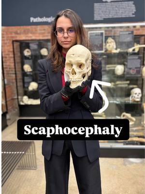 Scaphocephaly: or boat a shaped skull 🚢🧠✨ This condition, also known as sagittal craniosynostosis, causes the head to take on a long, narrow shape due to the early fusion of the sagittal suture. But what does that look like? In rbis video, we explore how it affects skull growth. Watch to learn how skulls like these reveal the incredible adaptability of the human body! #Scaphocephaly #Craniosynostosis #SkeletalAnatomy #bonemuseum 