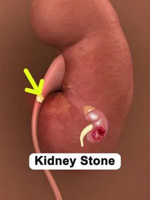 #kidneystone #kidney #kidneyfailure #kidneydetox #wellness #fyp #healthylife 