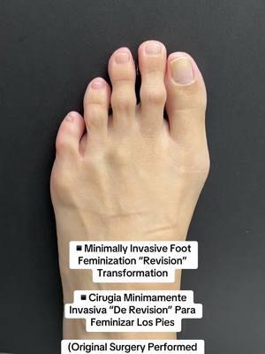 MINIMALLY INVASIVE FOOT FEMINIZATION “REVISION” TRANSFORMATION 🌟 👠Cosmetic Foot Surgery  🇪🇸Speak Spanish  🏖️Miami, Florida ☎️954 922 7333 📍Link In Bio  #foryoupage #footfeminization #toeshorteningsurgery #toeshortening 