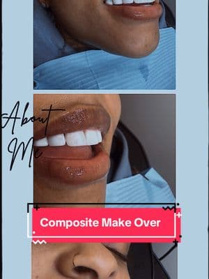 Reeeeeee Doooooo 🔥🔥🔥🔥 Composite Removed & Re Done 🥹😁  Want veneers removed from another tech ! We got you ! #memphiscompositeveneers #memphisteethwhitening #missingteeth #thingstodoinmemphis #memphisveneers 