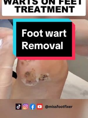 WARTS ON FEET TREATMENT AND FINAL RESULTS BY MISS FOOT FIXER #missfootfixer #feettreatment #foottreatment #footwarttreatment #footcornremoval 