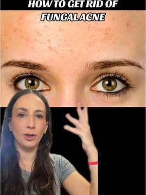 Replying to @Lily and Syrup HOW TO HELP GET RID OF FUNGAL ACNE #fungalacne #fungalacnetips #simpleskincareroutine #skincareforacne #preppyskincare #skincareforteens #skincarewithabby 