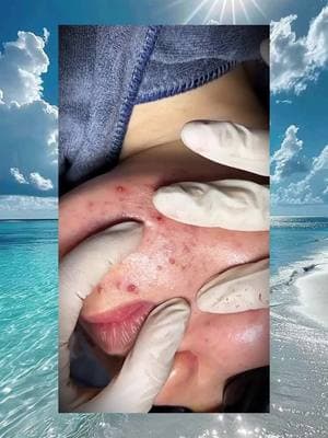 #pimples #blacheads #trending #relaxing #pimple #squeezing #squeeze #pimplepop #poping #acne