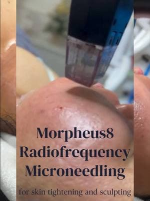 ✨ Sculpt, Tighten, Glow: Morpheus8 in Las Vegas! ✨ Transform your skin with Morpheus8, the groundbreaking treatment combining radiofrequency and microneedling for tighter, more sculpted skin. Whether you're tackling wrinkles, sagging, or uneven texture, this treatment delivers stunning, long-lasting results. 💎 📍 Located in Las Vegas, Halo Haus of Beauty is your trusted spot for expert Morpheus8 sessions. 👉 Ready to book? DM us or click the link in bio to schedule your consultation today! Let's bring out your best glow! ✨ #halohausofbeauty #halohausofbeautylv #lasvegasbeauty