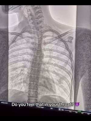 Yikes 🤯😥 Achalasia is a rare esophageal motility disorder caused by the degeneration of nerve cells in the esophagus, leading to impaired relaxation of the lower esophageal sphincter (LES). Patients typically experience difficulty swallowing, regurgitation, and chest pain. Diagnosis is confirmed through tests like esophageal manometry, and treatment options include pneumatic dilation, surgical myotomy, or botulinum toxin injections. #nurses #nurse #doctor #fyp #fypシ 