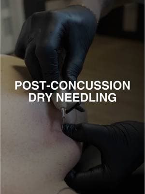 Post Concussion Dry Needles #physio #grandrapidsmichigan  #dryneedlingtherapy #physicaltherapy #hockey 