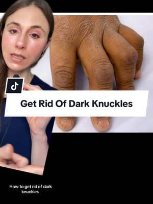 How To Get Rid Of Dark Knuckles. #darkknuckles #darkknuckletreatment #hyperpigmentation #dermatologist #creatorsearchinsights #greenscreen 