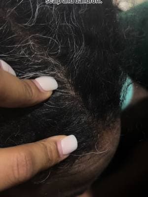 My husband struggles with dry scalp and dandruff, but after using our homemade hair products, his dandruff cleared up, and his scalp became hydrated. #fyp #fypシ #fypage #fypシ゚viral #fyppppppppppppppppppppppp #HomemadeHairCare #DIYHairProducts #NaturalHairRemedies #HealthyHairJourney #HairGrowthTips #DryScalpRelief #DandruffSolutions #ScalpHydration #NaturalHairGrowth #DIYScalpTreatment #HairCareHacks #HomemadeHairTteatment #HairGrowthJourney #FlakeFreeHair #ScalpCareTips #NaturalHairLovers #DandruffFree #NourishedScalp #HealthyScalpCare #DIYBeautyRoutine