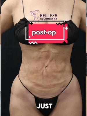 Imagine investing $30K in lipo only to risk it with cheap post-op care 💔 At Belleza Colombiana, your skin health and results are our top priority. With over 20 years of expertise, cutting-edge technology, and personalized treatments tailored to your needs, we ensure your investment is protected. Don’t settle for less—trust the best. 💎 #bbl #lipo #masajeslinfaticos #lymphaticdrainage #faja 