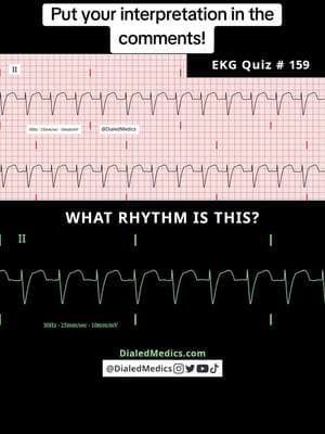 💻🫀🤔 All #EKG recordings are from the EKG rhythm generator on my website (LII rhythms only for now, 12Ls are in beta and coming soon), be sure to check it out for more software generated #ECG practice! (Link in bio.) #EMS #ACLS #emstok #paramedic #paramedicsoftiktok #medic #medicsoftiktok #flightmedic #criticalcareparamedic #paramedicstudent #paramedicschool #emta #emtb #emt #emtlife #emtsoftiktok #emtstudent #emtschool #firstresponders #NREMT #nurse #nursesoftiktok #RN #nursingstudent #nursingschool #flightnurse #criticalcarenurse #emergencynurse #NCLEX #nclexrn #nclexprep #doctor #doctorsoftiktok #medicalstudent #USMLE #emergencymedicine #criticalcare #cardiology #FOAMED 