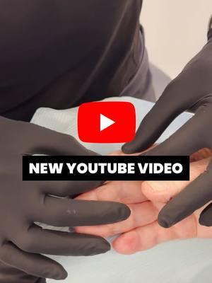 ⁣ ⁣ New YouTube joint just dropped …⁣ ⁣ #pimplepopper #pimplepopping #youtube #youtuber #drmudgil #nycdermatologist ⁣#thedoc #thedoctok ⁣ ⁣ ⁣ ⁣ ⁣ ⁣ ⁣ ⁣ ⁣ ⁣ ⁣ ⁣ ⁣