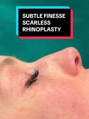 Small or Big Bumps - strategic subtle finesse is the key to keep a natural dorsum that never looks operated on.  For immediate assistance, visit: https://www.scarlessnose.com/contact and our concierge team will respond promptly!  Ready to book a consultation? Visit https://www.scarlessnose.com to schedule a virtual or in-person consultation.  At Beverly Hills Rhinoplasty Center, Dr. Dugar exclusively performs Closed Scarless Nose® Rhinoplasty as 100% of his surgical practice! 📞 Call/Text (USA): (424) 722-3484 🌍 International (WhatsApp): (+1-310-276-1703) #nosejob #rhinoplasty #scarlessnose #closedrhinoplasty #bestrhinoplastysurgeon #scarlessrhinoplasty #scarlessrhinoplasty #scarlessnosejob #bestnosejob  #drdugar #fyp 