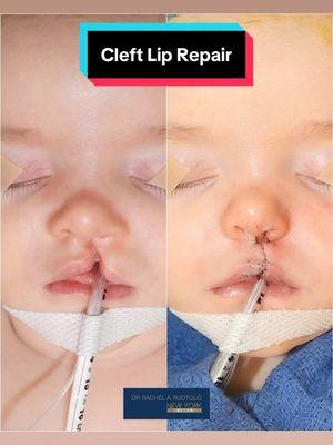 Hi 👋🏼 everyone!! Remember yesterday’s #cleftcutie!? She is seen here  BEFORE and immediately AFTER her unilateral cleft lip 👄 and nasal 👃🏼reconstruction. Watch 👀 this video 🎥 to view her on-table cleft lip 👄 and nasal 👃🏼 transformation!  Stay tuned for updates on her progress over the next few weeks and months! Goal: To help make children WITH clefts look like children WITHOUT clefts. Mission: Transforming children’s lives one smile at a time. These images are the property of Dr. Rachel A. Ruotolo and NYPSG and are not authorized for use by any other party. This is my actual patient with real results who has given informed consent (directly or indirectly via parents) to appear on my website and social media pages. #makingsmiles #cleftliprepair #smile  #cleftlip #cleft #cleftmom #cleftdad