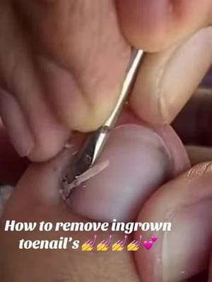 How to remove ingrown toenail’s!💅💅💅💕❎Stop looking 👀.. .Starting …🫵 Calling and Bookings ….210-733-6634. We we 🔥🔥SPECIAL OFFERS🔥🔥-Get 10%off on main services for TEACHERS on MONDAY (must present badge )-Get 10%off on main services for STUDENTS on TUESDAY (must present your ID)-Get 10%off on main services for MEDICAL STAFFS on WEDNESDAY (must present badge)- Birthday 10%Discounts (must present your ID)#Regalnailvancejackson#Sanantonionails #sanantonionailsar#sananto nails#nailsdesign #nailswagg #swarovski #swarovskinails #photoshoot#holidaynails#toenails #toenailsimplan##pinterest #trendingnails #nailsmagazine#thebestnailsinsanantonio  #nails #sanantonio #nailsontiktok #nailsnailsnails #nailsart #viral #fortoypage #foryoupage #nailsofinstagram #s seei