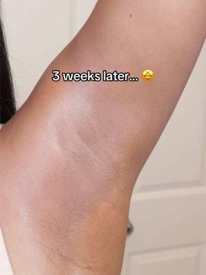 Like common #darkspots #darkarmpits #darkunderarms #hyperpigmentation 