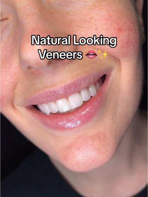 The most natural transformation 🤯🌟 #veneers #naturalveneers #veneersjourney #naturallook #veneerteeth #porcelainveneers #yoursmile 