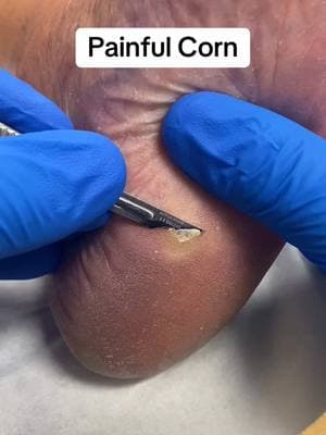 Painful Corn Removal for Instant Foot Pain Relief 😮‍💨 #satisfying #oddlysatisfying #runner  (via docpods/tt)