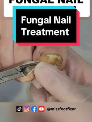 Fungal Nail Infection #fungalnail #fungalnailinfection #fungalnailtreatment #toenailfungustreatment #missfootfixer 