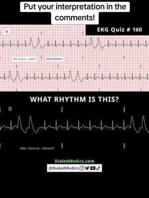 🔗🫀🤔 All #EKG recordings are from the EKG rhythm generator on my website (LII rhythms only for now, 12Ls are in beta and coming soon), be sure to check it out for more software generated #ECG practice! (Link in bio.) #EMS #ACLS #emstok #paramedic #paramedicsoftiktok #medic #medicsoftiktok #flightmedic #criticalcareparamedic #paramedicstudent #paramedicschool #emta #emtb #emt #emtlife #emtsoftiktok #emtstudent #emtschool #firstresponders #NREMT #nurse #nursesoftiktok #RN #nursingstudent #nursingschool #flightnurse #criticalcarenurse #emergencynurse #NCLEX #nclexrn #nclexprep #doctor #doctorsoftiktok #medicalstudent #USMLE #emergencymedicine #criticalcare #cardiology #foamed 