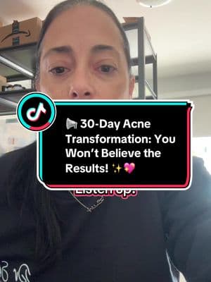 🚨 Struggling with acne? Watch this jaw-dropping 30-day before-and-after journey using Dr. Skin Acne Calm—a powerhouse blend of natural botanicals, omega-rich oils, and skin-repairing nutrients. 🌱✨ ✅ Clears stubborn breakouts ✅ Fades dark spots & scars ✅ Reduces redness & inflammation ✅ Restores a healthy, glowing complexion 🔬 No chemicals. No toxins. Just real results. 🔥 WATCH till the end for the shocking transformation! #AcneBeforeAfter #ClearSkin #DrSkinBeauty #NaturalAcneTreatment #GlowingSkin #acne #clearskin #glowing #glowingskin #acnescars #beautiful #fyp #fypシ 