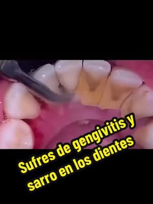 Te sangran las encías, tienes cálculos y sarro pues te tengo la solución! #sarro #calculos #dental #limpieza #gengivitis #malolor #placadental #electrico #desdecasa 