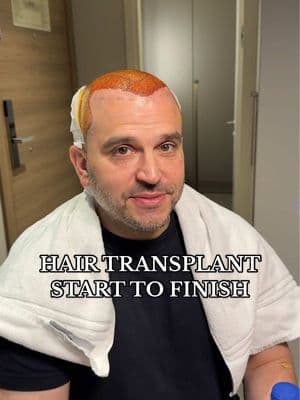 This is what it looks like to get an 11 hour hair transplant in Turkey. If you have any questions, please drop them in the comments! #hairtransplant #turkey #hairrestoration #hairtransplantturkey #hairtransplantsurgery