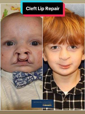 Hi 👋🏼 everyone! Watch the following video 🎥  cataloging our sweet patient, Rowan, over the last 7.5 years following his bilateral cleft lip and palate reconstruction.  It is so very important for parents to see and understand the many changes that occur to the lip, nose and scar during the months and years following their baby’s cleft repair.  The lip is often pink and firm for months after the surgery. The scar may also become raised and/or contract, causing shortening of the lip making it appear as if the cleft is recurring. 😳 I try my best to reassure parents during this time and encourage them to apply scar ointment and massage daily. As you can see in this video 🎥, that patience and time ⏰ are essential in allowing the lip and nose to soften and settle. 👌🏻 We also follow the child’s speech very closely following cleft palate repair. It is often underestimated how important communication is in our daily lives.  Mission: Transforming children’s lives, one smile 😃 at a time.  Goal: To help make children WITH clefts look like children WITHOUT clefts 💪🏻👌🏻.  These images are the property of Dr. Rachel A. Ruotolo and NYPSG and are not authorized for use by any other party. This is my actual patient with real results who has given informed consent (directly or indirectly via parents) to appear on my website and social media pages. #cleftlip #cleft #cleftliprepair #bilateralcleftlip #cleftpalaterepair #bilateralcleftpalate