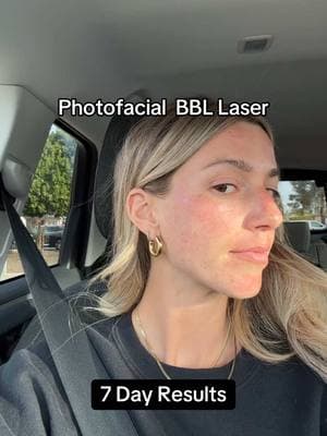 The freckle mustache though 🥹🤠 #bbllaser #bbllasertreatment #facelaser #laserface #facialtreatment #lasertreatments #photofacial #progress 