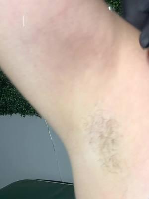 Underarm waxing tutorial using soft wax🔥 Yes, you can go over the same area twice as long as you prep the skin correctly 👏🏼  If you’re looking to get slower, finer and thinner regrowth before the summer starts, make sure you start your waxing journey now !  #waxingvideos #tutorial #waxingtutorial #waxingforbeginners #softwax #waxingtiktok #waxerlife #fyp 