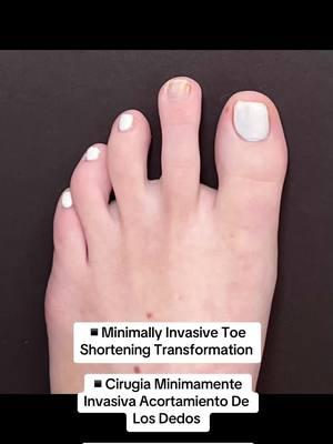 MINIMALLY INVASIVE TOE SHORTENING TRANSFORMATION 🩷 👠Cosmetic Foot Surgery  🇪🇸Speak Spanish  🏖️Miami, Florida ☎️954 922 7333  📍Link In Bio  #toeshorteningsurgery #toeshortening #acortamientodelosdedos #longtoes #cosmeticfootsurgeon #cosmeticfootsurgery 