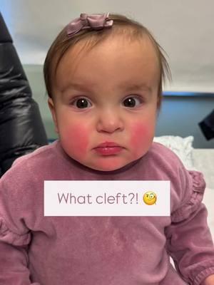 Happy Friday!! ☺️ This cleft cutie 🥰 is seen here 8 months following her right incomplete cleft lip 👄 repair and 6 weeks following her cleft palate repair. Mission: Transforming children’s lives, one smile 😀 at a time. Goal: To help make children WITH clefts look like children WITHOUT clefts. 💪🏼👌🏼 These images are the property of Dr. Rachel A. Ruotolo and NYPSG and are not authorized for use by any other party. This is my actual patient with real results who has given informed consent (directly or indirectly via parents) to appear on my website and social media pages.  #cleftlip #gardencity #babylon #nyc  #cleftliprepair #cleftmom #cleftdad #cleft #cleftpalaterepair