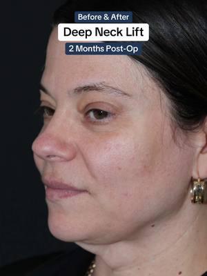 This beautiful patient came to see me with concerns about excess skin in her neck, a result of neck liposuction performed by another doctor. For most patients over 40, liposuction alone can lead to unwanted results, such as excess sagging skin. With the help of a Deep Neck Lift and Lower Facelift, we were able to address the loose skin and create a smooth, rejuvenated neckline. 🌟 At just 2 months post-op, her results are already incredible, giving her a much more youthful, defined appearance. 💖 #montreal #facialplasticsurgeon #necklift #deepnecklift #jawlinecontour #plasticsurgery #jawline #neckliposuction 