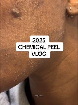 Let’s get this skin maintenance going for 2025! My esthi (and I lol) decided to do a light PCA chemical peel to help with some of my lingering hyperpigmentation and dark spots.  Ngl I was nervous because I felt like my before and after pictures of the chemical peel weren’t showing much progress but now that I’m a few weeks out, my skin looks good! And the post inflammatory hyperpigmentation is almost out of here.  #chemicalpeel #chemicalpeelblackskin #chemicalpeelprocess #hyperpigmentationtreatment #beforeandafter #hormonalacne  #acneproneskin   #blackgirlwithacne #blackgirltiktok @PCA SKIN 