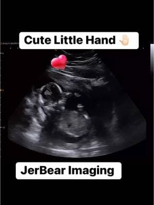 Cute Little Hand  #jerbearimaging #cutebaby #babyhands #pregnancy #15weeks5days #foryoupagereels #ultrasoundnearme #fyp #newmomlife #momclub #dadclub #hands  #babylove #browncounty #peaceofmindmatters #peaceofmind #happy  #soloved #UltrasoundCenter www.jerbearimaging.com