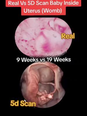 Real Vs 5d scan baby inside Womb during ultrasound scan #babyinsidebelly #babyinside #babyinsidewomb #babyultrasoundscan #ultrasoundscan #pregnancyjourney #babymovinginbelly #babyinbelly #9weeksvs19weks #realbaby #babyinsidebelly 