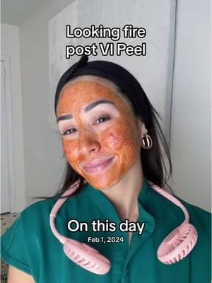 #onthisday pookie looked fire, I felt fire 🔥 jk it’s not as bad as it looks #vipeel #vipeelprecisionplus #chemicalpeel #chemicalpeeling 