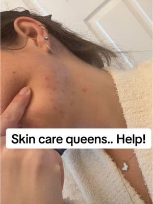 Skincare queens.. 🆘 I got a facial about 2 weeks ago.. microdermabrasion & dermaplaning and ever since under my chin / jaw area is breaking out terribly. I’ve never really had this be a problem area before.. what can I do to fix & calm this down? #acneskin #acnehelp #breakingout 