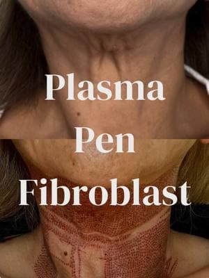 Say goodbye to sagging skin and hello to a smoother, tighter neck! Our Plasma Pen Fibroblast treatment stimulates collagen production, reducing fine lines, wrinkles, and loose skin for a youthful, lifted look. Perfect for tackling those stubborn necklines without surgery!   Downtime: Expect some redness, swelling, and tiny scabs for 5-7 days as your skin heals and works its magic. The results? Long-lasting, firmer skin that keeps getting better over time! #halohausofbeauty#halohausofbeautylv#lasvegasbeauty#lasvegastiktok#plasmapentreatments#PlasmaPen Ready to turn back the clock?