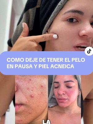 Esto es realmente mágico después de 1 mes de tomarlo ya logré ver resultados ✨💜 . . #tiktokshopjumpstartsale #TikTokShop #fyp #paratii #beauty #eeuu #skin #mujeres #tipsmujeres #latinas #colageno #resveratrol #biotin #acidohialuronico #tiktokshopjumpstartsale #TikTokShop #fyp #paratii #beauty #mujeres #videoviral #cuidadodelapiel #viraltiktok #cabellolargo #pielbonita #supplements #fuel #colageno #colagenohidrolizado #collagen #resveratrol #usa 