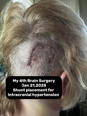 Shunt placement for Intracranial Hypertension (Right Sided Ventriculoperitoneal Shunt) #sharjosie #brainsurgery #fourbrainsurgeries #armymom #cerebralshunt #microvasculardecompression #iih #idiopathicintracranialhypertension #glossopharyngealneuralgia #brainsurgerysurvivor #covidlonghauler #stuartflorida 