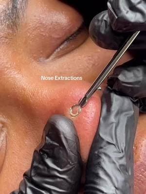 Nose extractions ✨😍 #atlantaesthetician #atlskincareblogger #atlesthetician #noseextraction #skinextractions #estheician #facials #atlantafacial #mariettafacial #mariettaesthetican #atllashes #atlantafacials #facialvideo #viral #explorer #skincare #extractions #extractionsatisfaction 