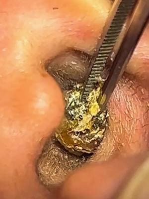 #earwax #acne #satisfying #earwaxremoval #asmr #earcleaningvideos #ceradeouvido #earwaxcleaning #limpezadeouvido 