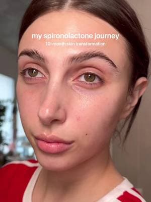 literally life changing 😭 ilyy #spironolactone ❤️❤️ #skincare #skincarejourney #spironolactonejourney #acnetreatment #acnetransformation 