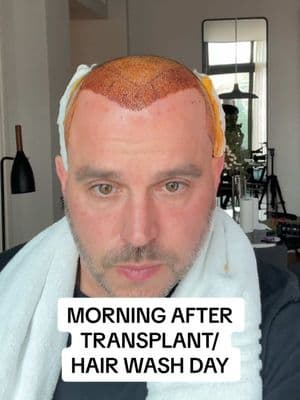 Morning after hair transplant and wash day #hairtransplant #hairtransplantturkey #hairtransplantsurgery 