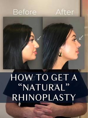 Want your nose to look brand new, but completely natural? 👀 Despite the myths, plastic surgery doesn’t have to look overdone. 🌟Here’s how to achieve a natural rhinoplasty:  ▶ Tip & Dorsum: Balanced—not too narrow, not too wide. ▶ Profile Harmony: The tip & dorsum should complement your face from all angles. ▶ Surgical Approach: A closed, scarless technique (my go-to!) enhances natural results. ▶ Clear Communication: Tools like VECTRA 3D Imaging help align expectations. I always use this with my patients to give them a preview and to get on the same page 📍 Want to make your dream nose a reality? Consult with us today!  📞 (212)-203-8623 💻 www.albertplasticsurgery.com 📍 950 Park Avenue, New York, NY  #rhinoplasty #nosejob #septoplasty #closedrhinoplasty #rhino #scarlessrhino #plasticsurgery #nycplasticsurgery #nycrhinoplasty #plasticsurgeon #nosejobbeforeandafter #NoseSurgery #scarlessrhinoplasty #NYC #transformation #beforeandafter #alarsillreduction #alarsill #deviatedseptum #septum #fyp #foryou #foryoupage 