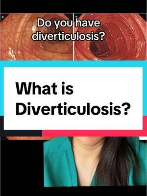 Do you have diverticulosis? Here is how I explain this common condition to my patients and how this is different from diverticulitis #gut #guthealth #diverticulitis #diverticulosis #colonoscopy #backtobasics #LearnOnTikTok #gastroenterology 