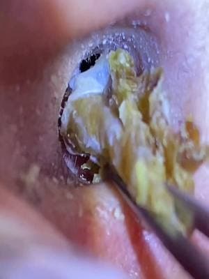 #earwax #acne #satisfying #earwaxremoval #asmr #earcleaningvideos #ceradeouvido #earwaxcleaning #limpezadeouvido 