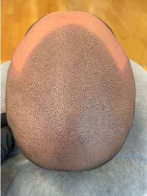 Can you tell this is a hair tattoo? #scalpmicropigmentation #hairtattoo #scalptattoo #fyp #hairloss #scalpmicrousa #micropigmentacion 